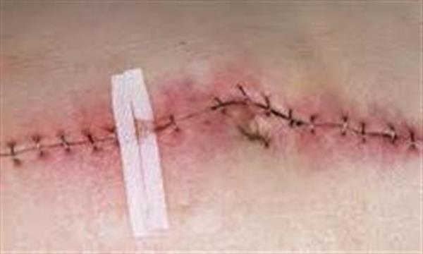 گامی به سوی ساخت پماد ضدعفونی کننده زخم‌ها بعد از جراحی