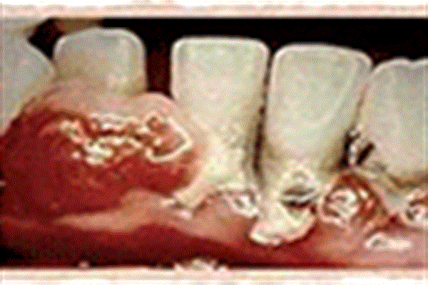 بهبودی عفونت دندان با بهره‌گیری از نانوالماس